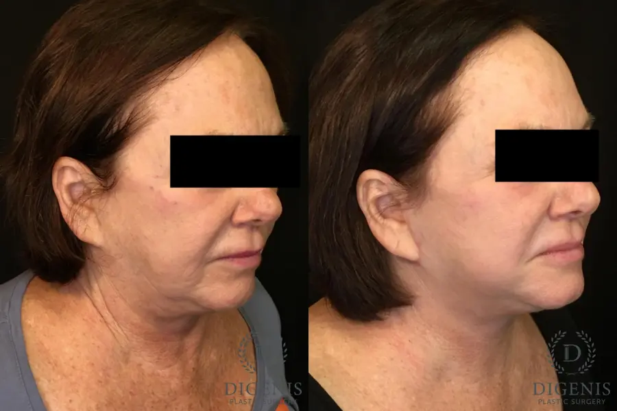 Facelift: Patient 13 - Before and After 2