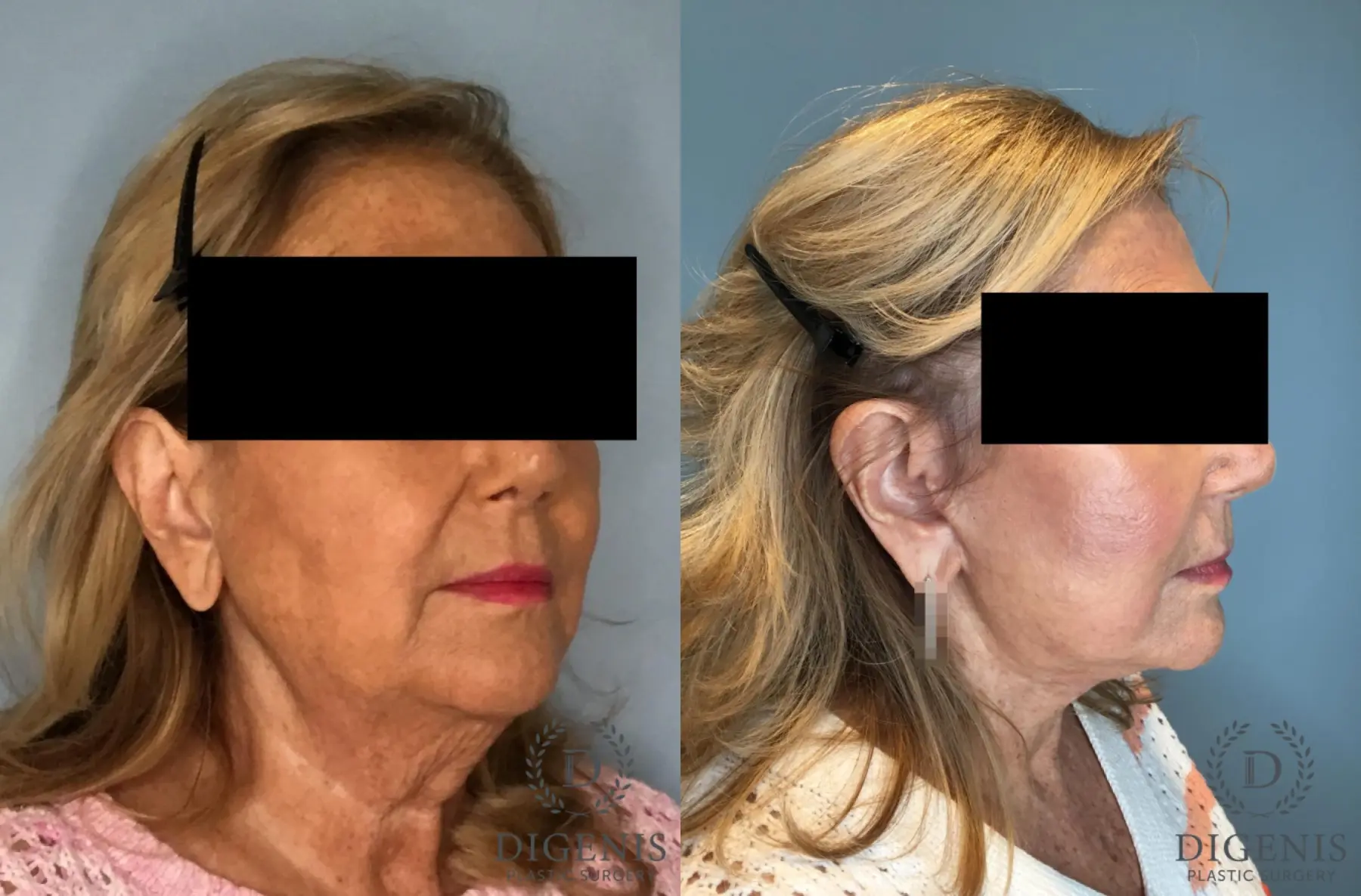 Facelift: Patient 69 - Before and After 2