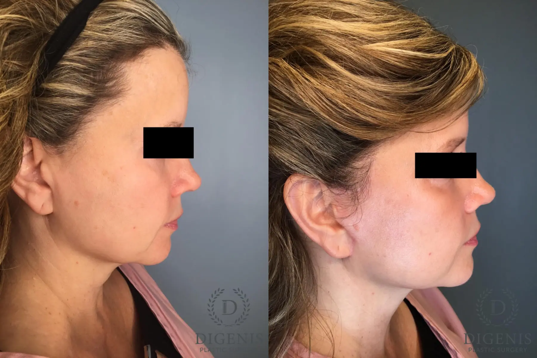 Facelift: Patient 60 - Before and After 5