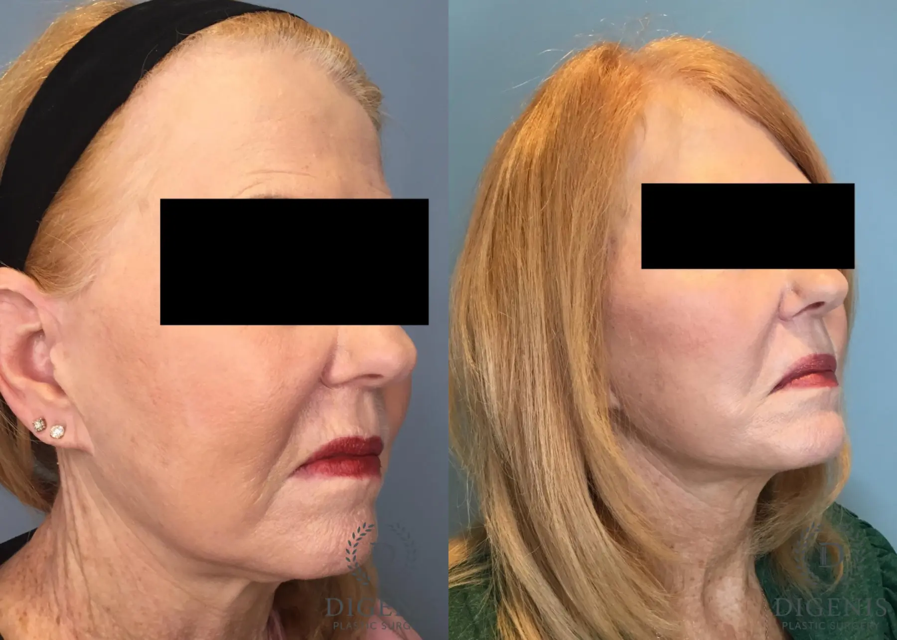Facelift: Patient 67 - Before and After 4
