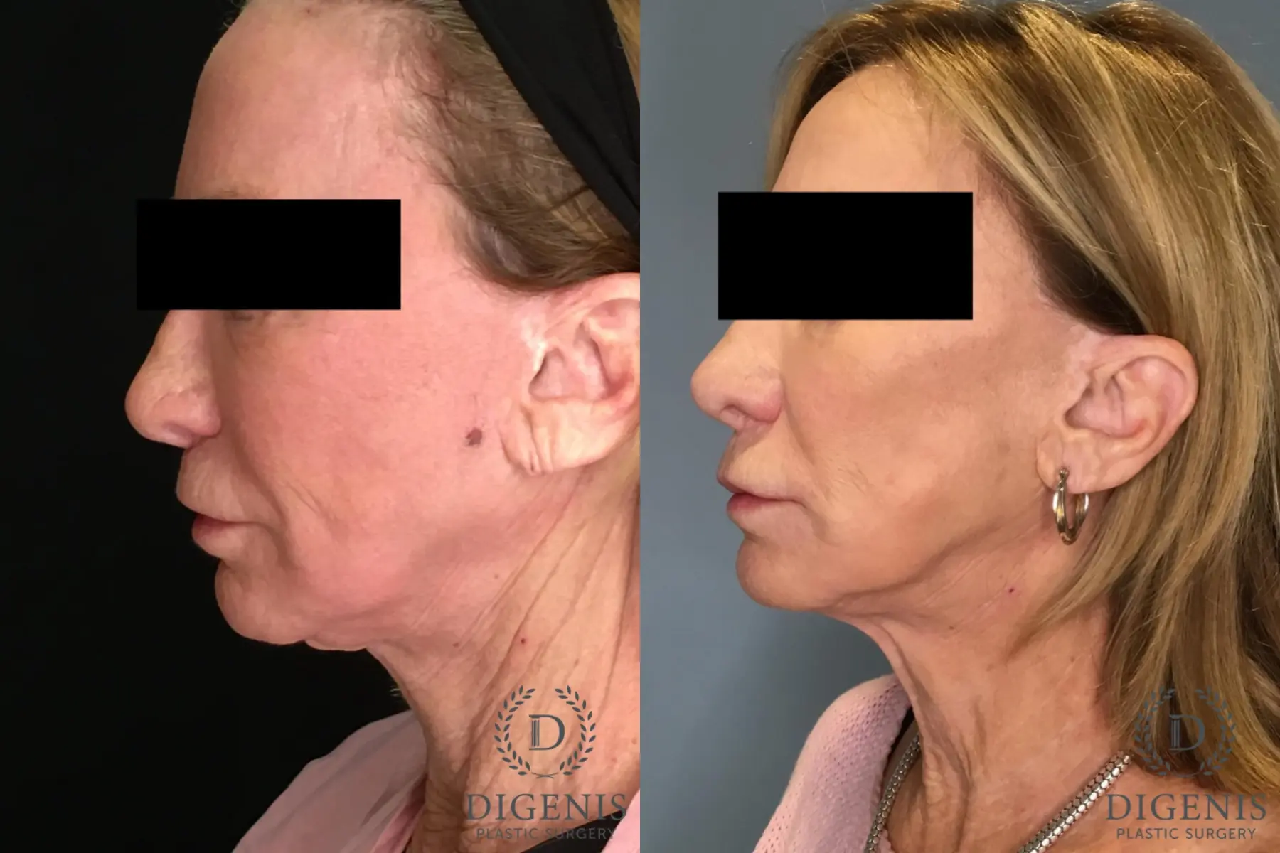 Facelift: Patient 64 - Before and After 3