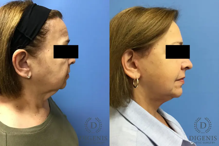 Facelift: Patient 7 - Before and After 3
