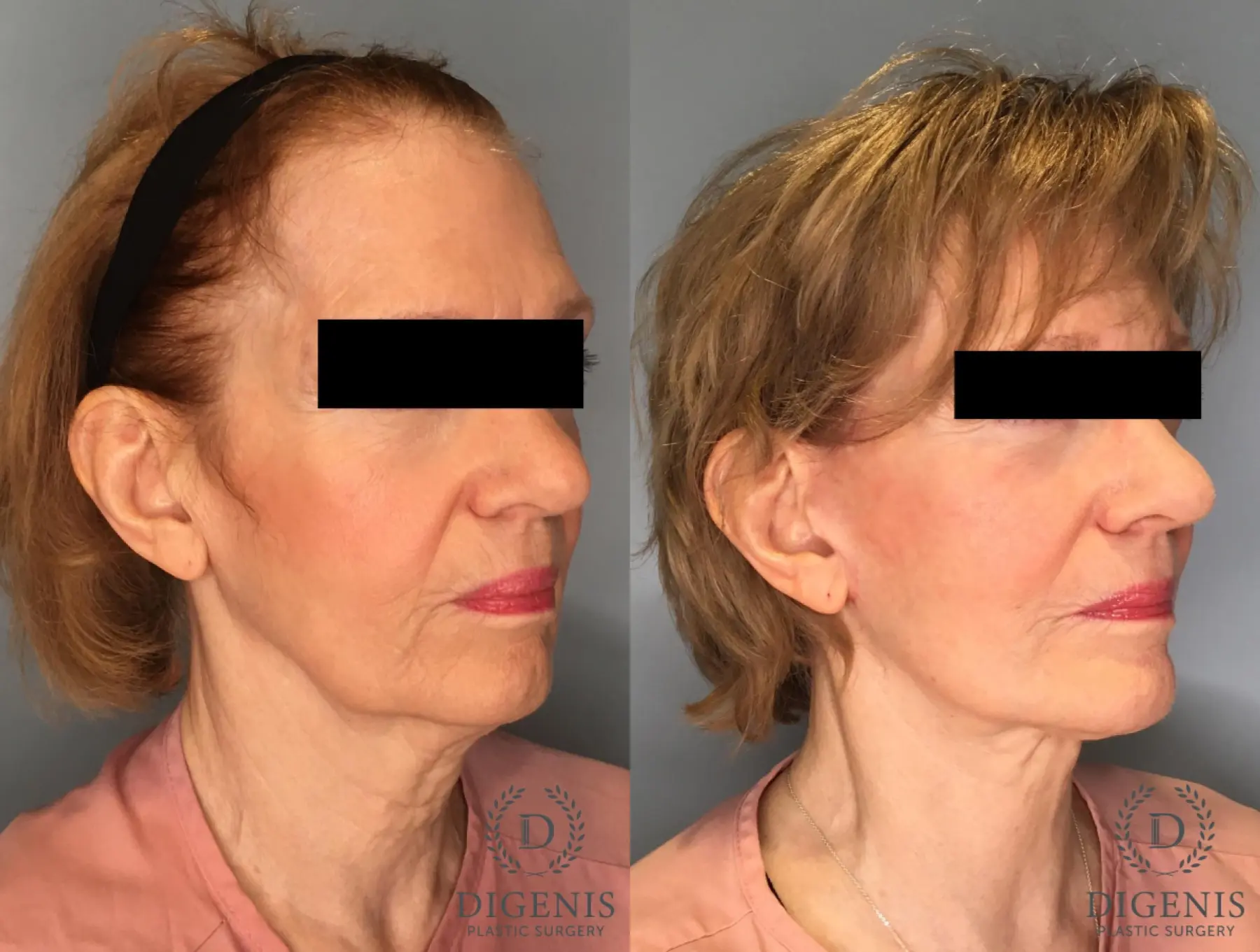 Facelift: Patient 21 - Before and After 2
