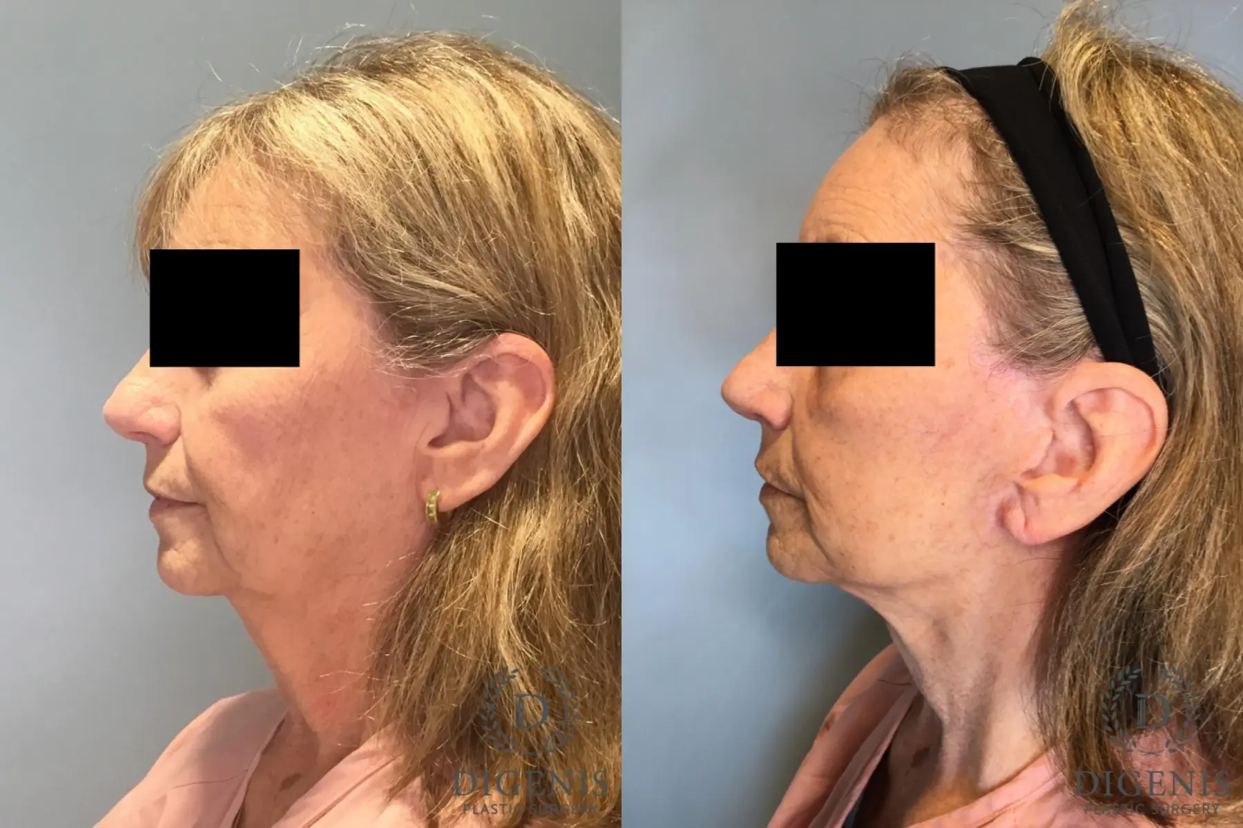 Facelift: Patient 20 - Before and After 3