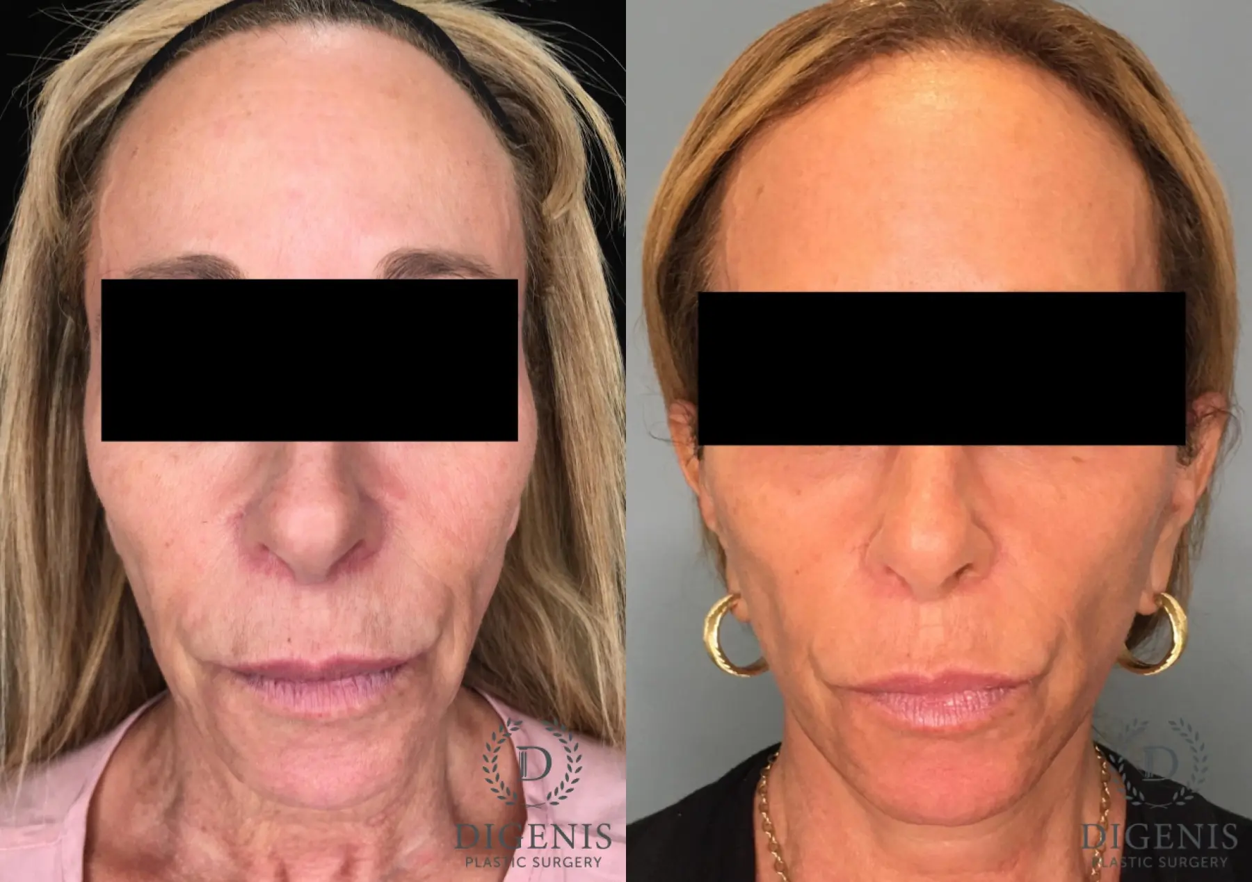 Facelift: Patient 35 - Before and After  