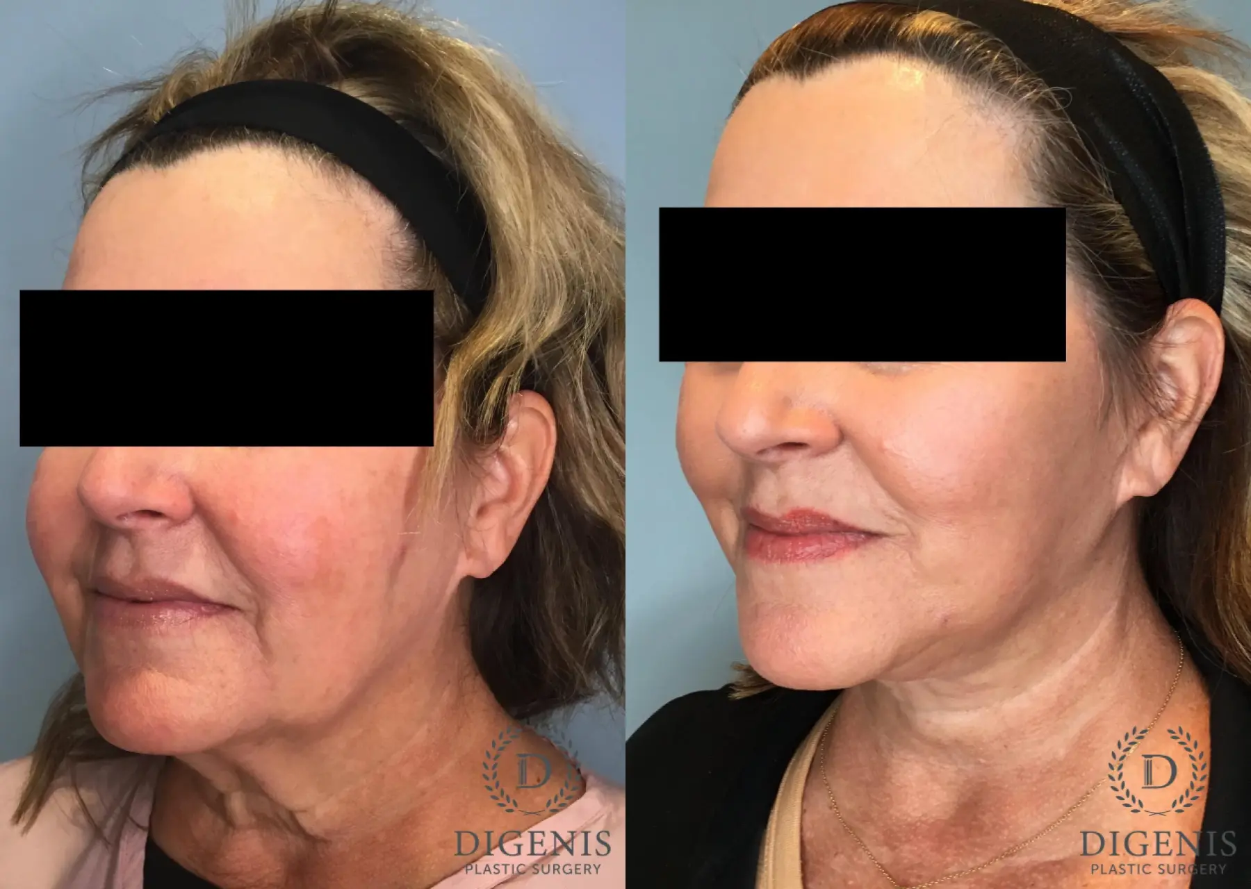 Facelift: Patient 61 - Before and After 2