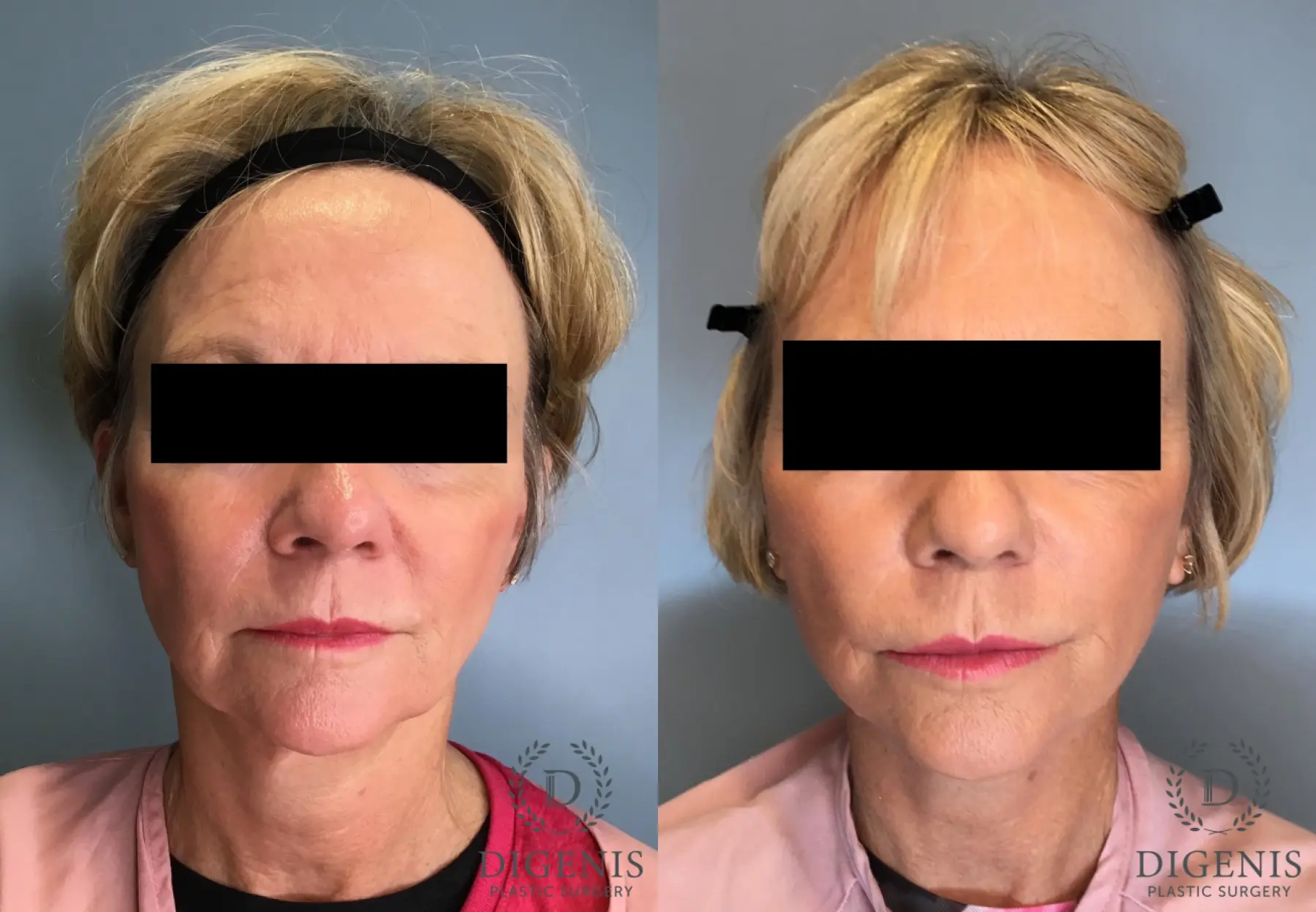 Facelift: Patient 14 - Before and After  