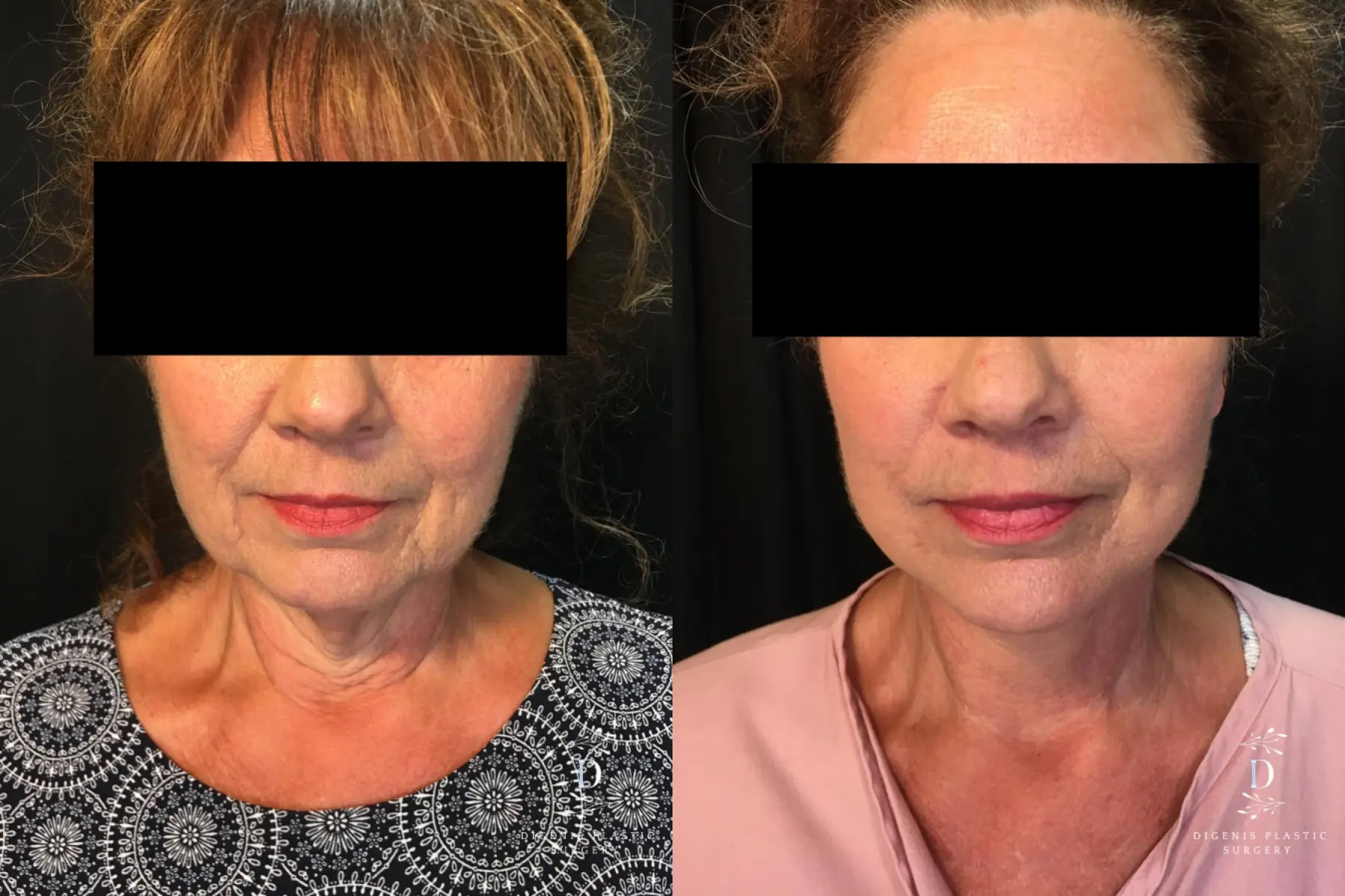 Facelift: Patient 20 - Before and After  