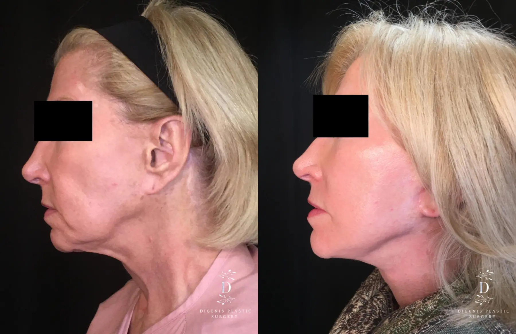 Facelift: Patient 21 - Before and After 5
