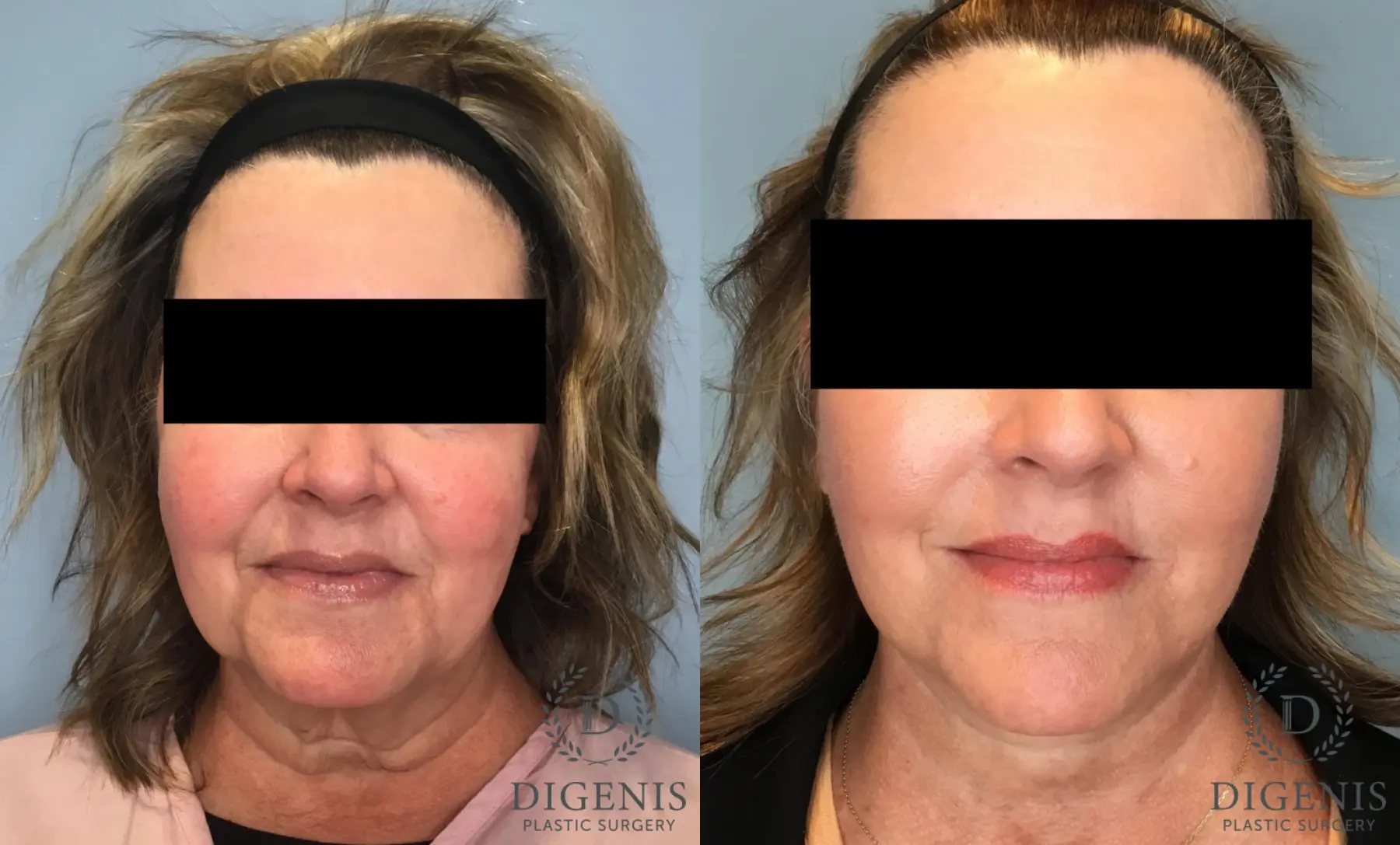 Facelift: Patient 61 - Before and After  