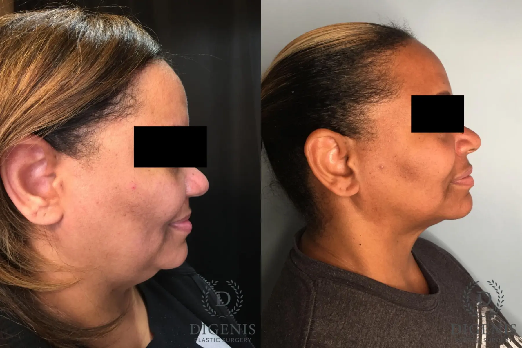 Facelift: Patient 63 - Before and After 3