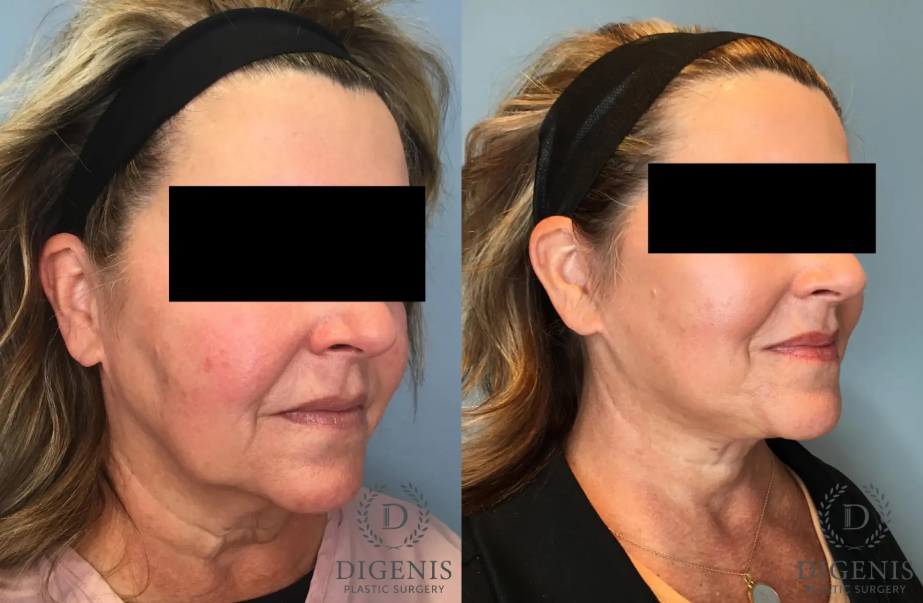 Facelift: Patient 61 - Before and After 4