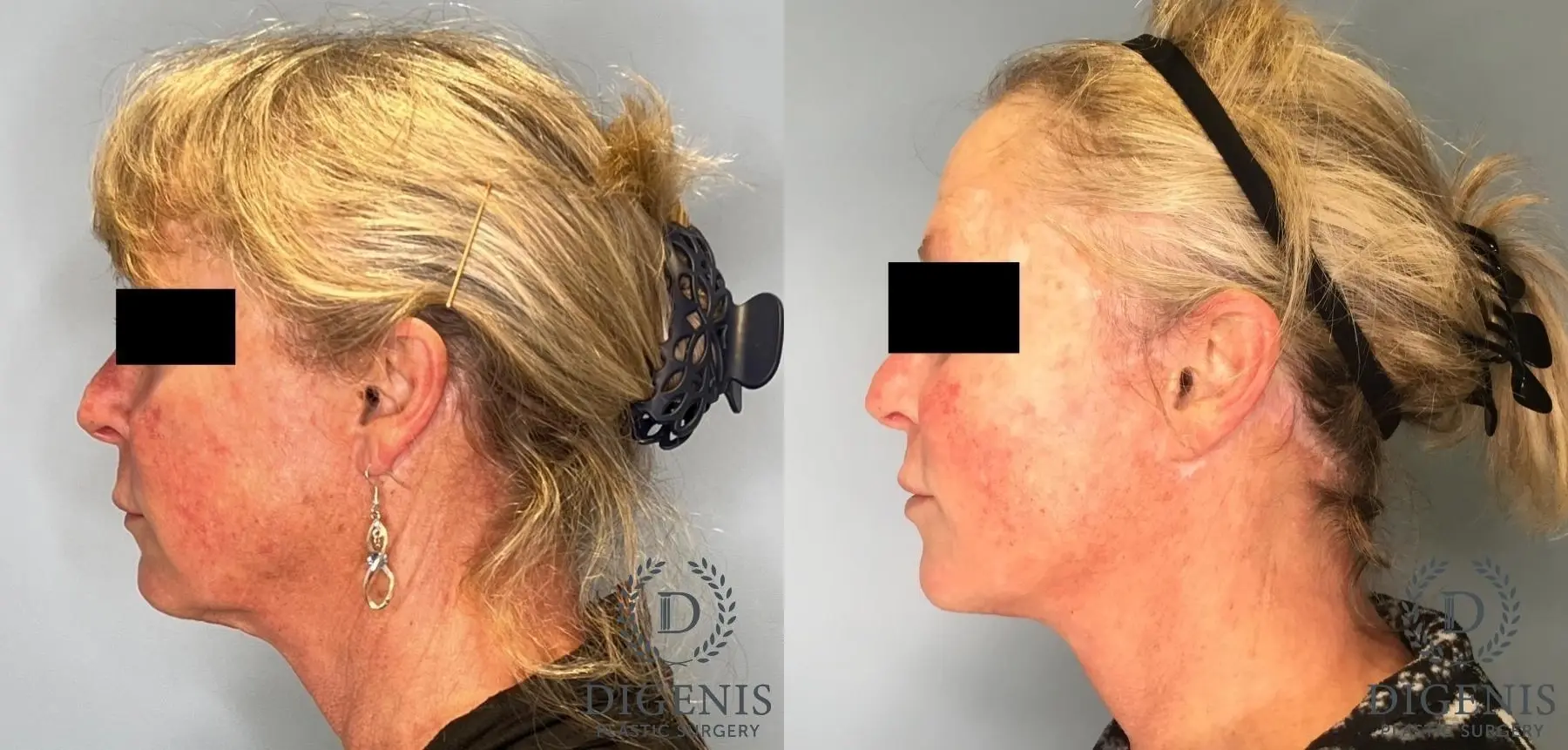 Facelift: Patient 17 - Before and After 4