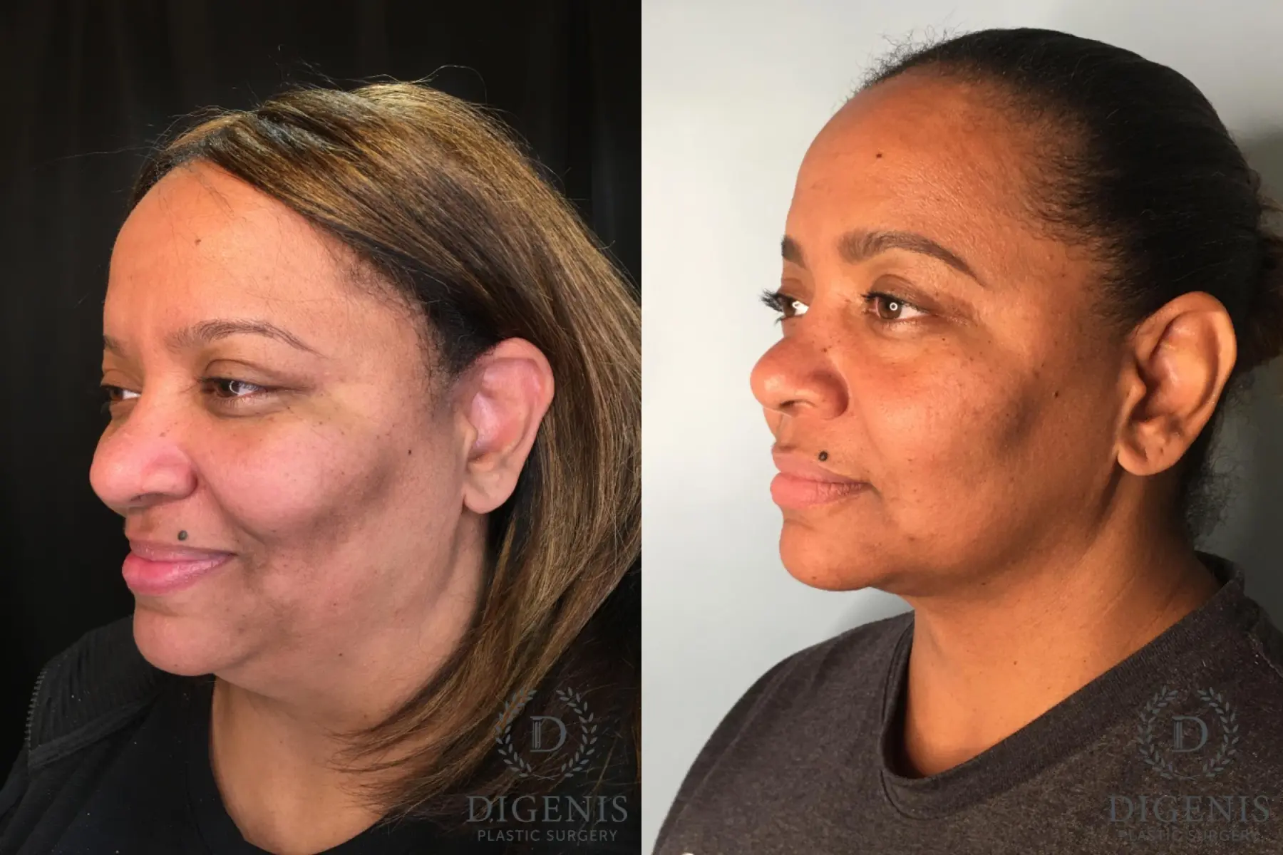FaceTite: Patient 1 - Before and After 4