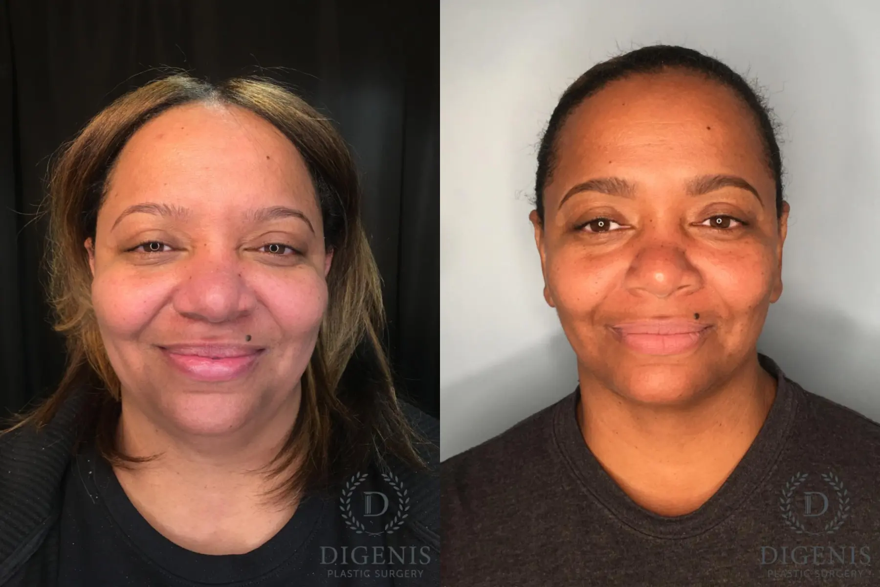 FaceTite: Patient 1 - Before and After 1