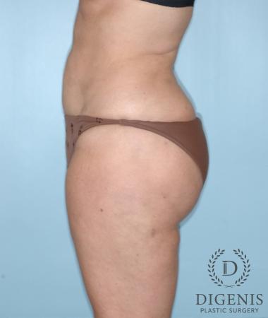 Liposuction: Patient 4 - After 4