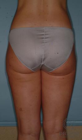 Liposuction: Patient 3 - After 2