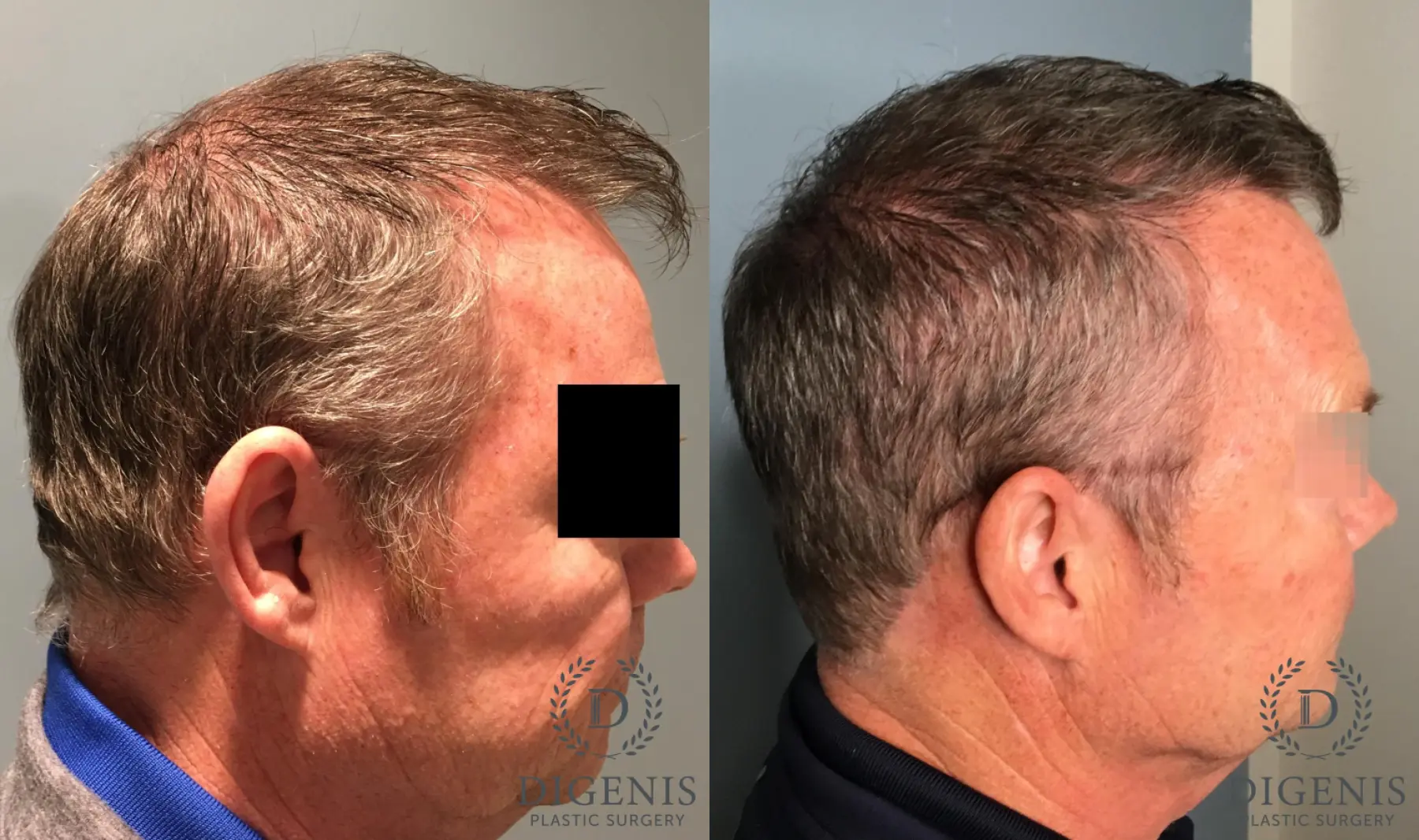 Hair Loss Treatment: Patient 2 - Before and After 2