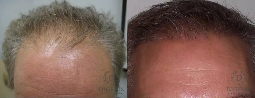 Hair Loss Treatment: Patient 1 - Before and After  