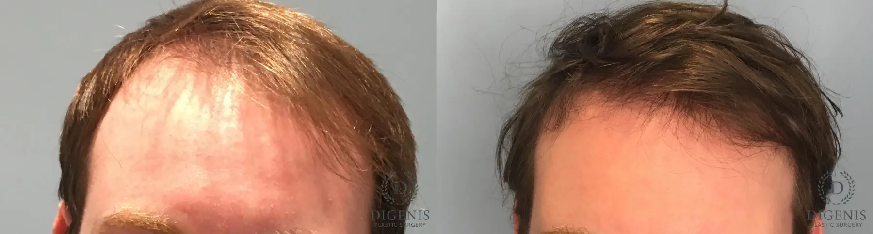 Hair Loss Treatment: Patient 7 - Before and After  
