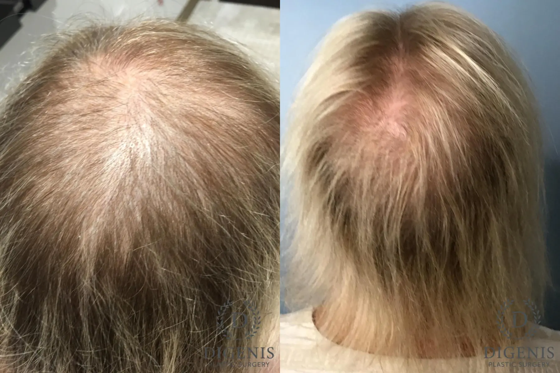 Hair Loss Treatment: Patient 1 - Before and After  