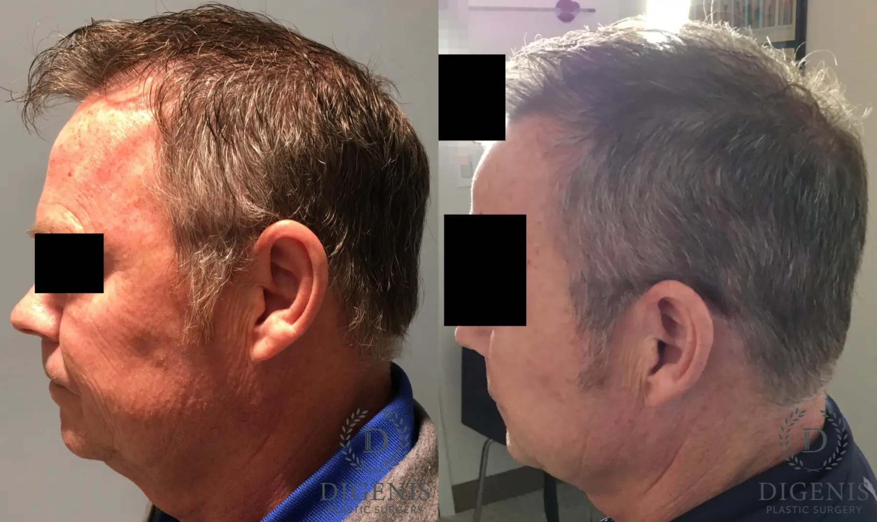 Hair Loss Treatment: Patient 2 - Before and After 3
