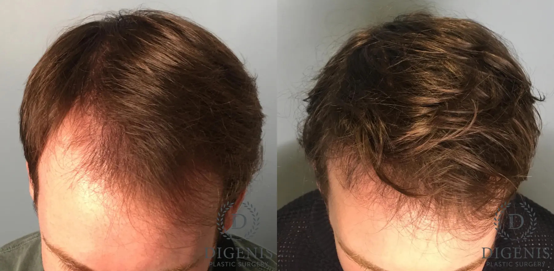 Hair Loss Treatment: Patient 7 - Before and After 2