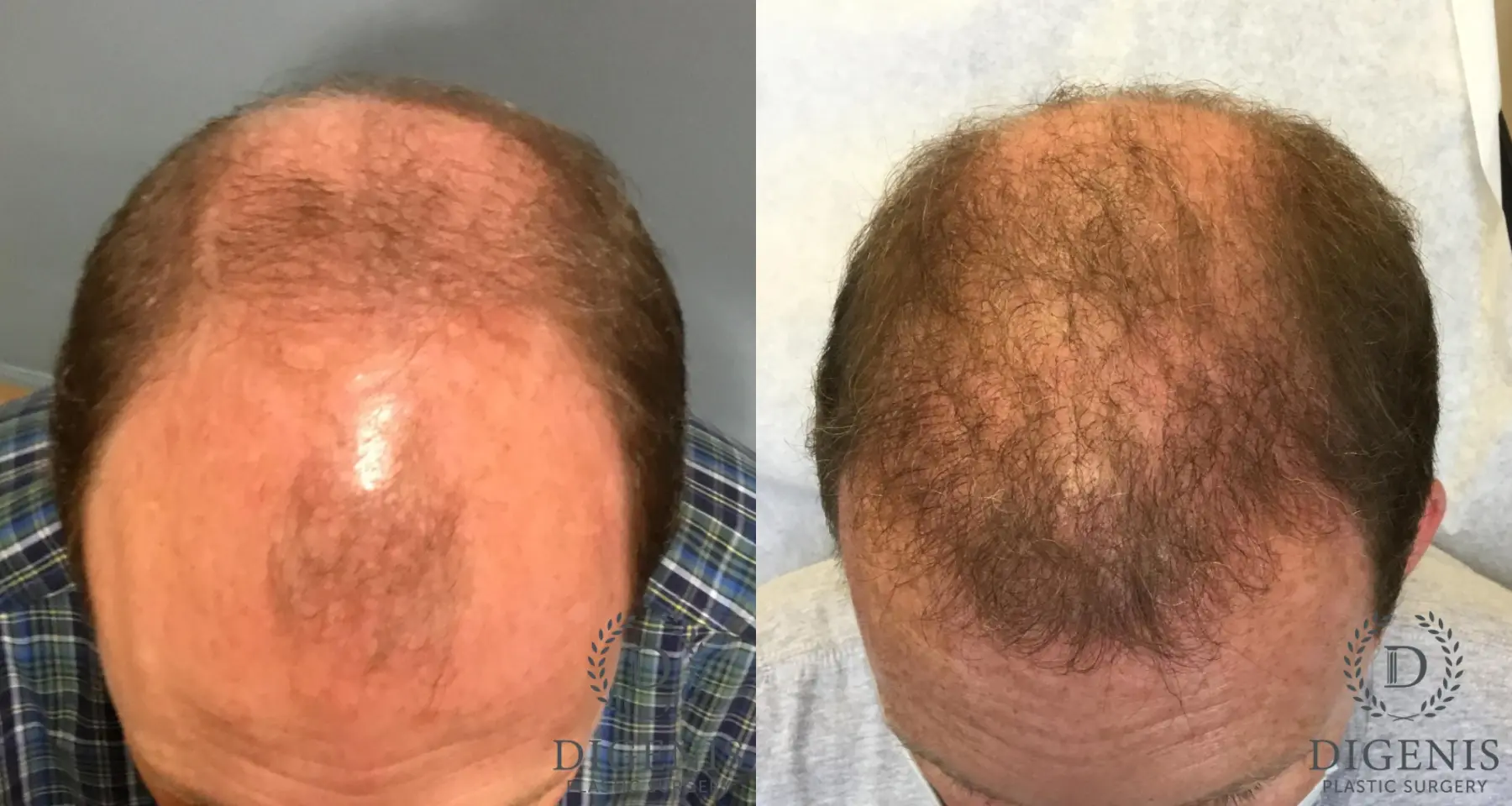 Hair Loss Treatment: Patient 5 - Before and After  