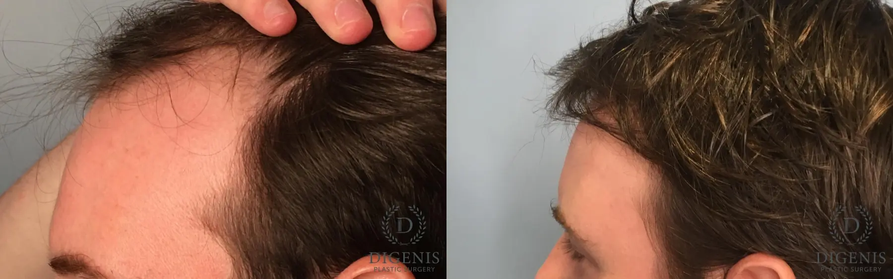 Hair Loss Treatment: Patient 7 - Before and After 4