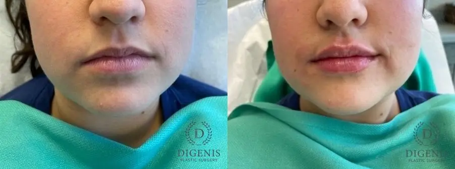 Injectables: Patient 1 - Before and After 1