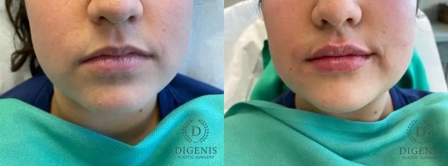 Injectables: Patient 1 - Before and After  