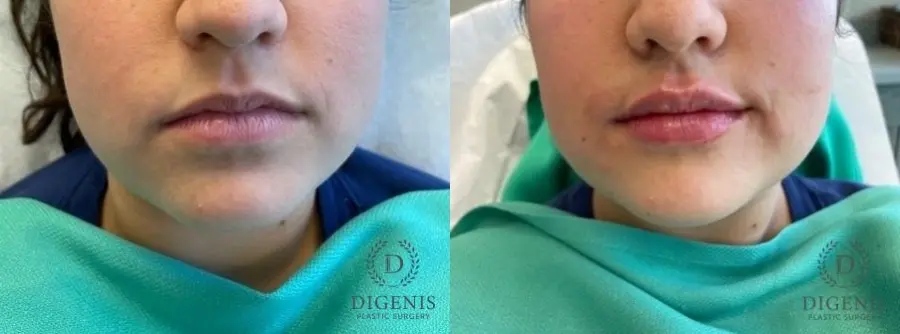 Injectables: Patient 1 - Before and After 1