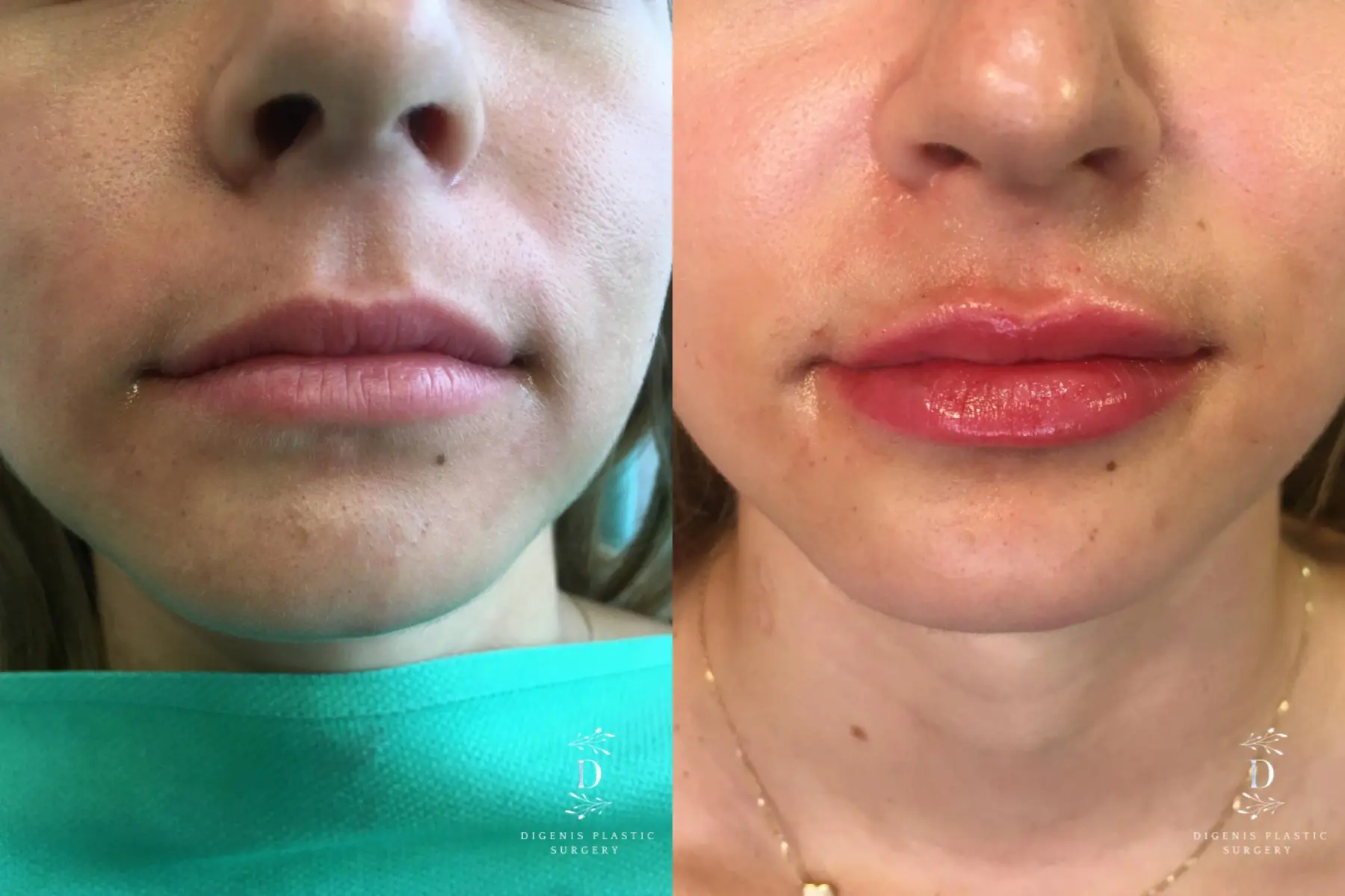 Injectables: Patient 2 - Before and After  
