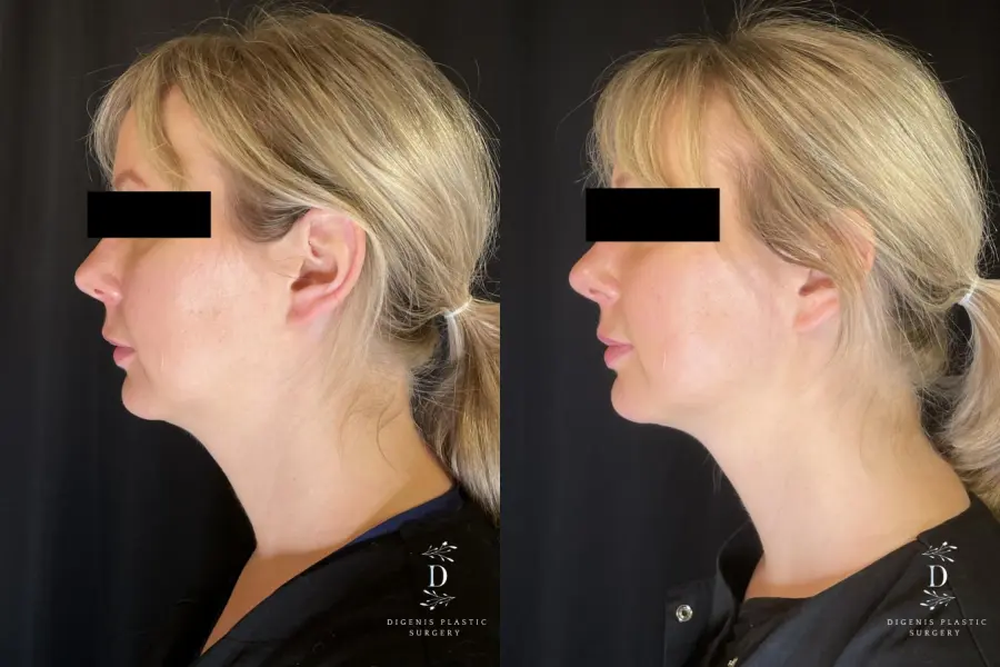 Injectables: Patient 3 - Before and After 2