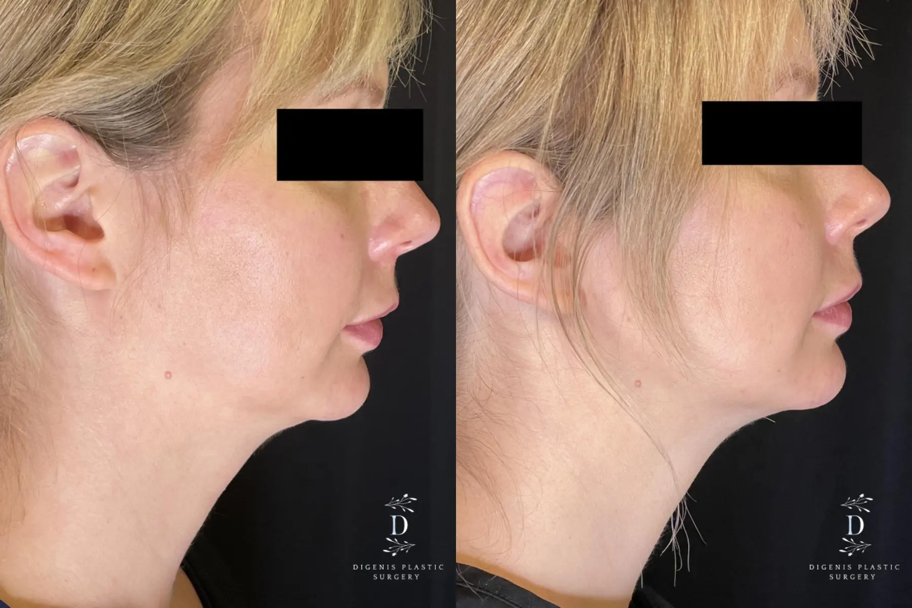 Injectables: Patient 3 - Before and After  