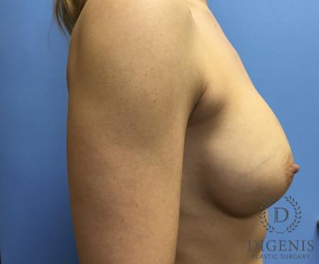Breast Augmentation: Patient 2 - After 3