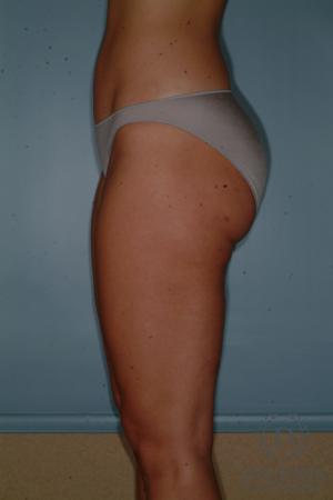 Liposuction: Patient 3 - After 4