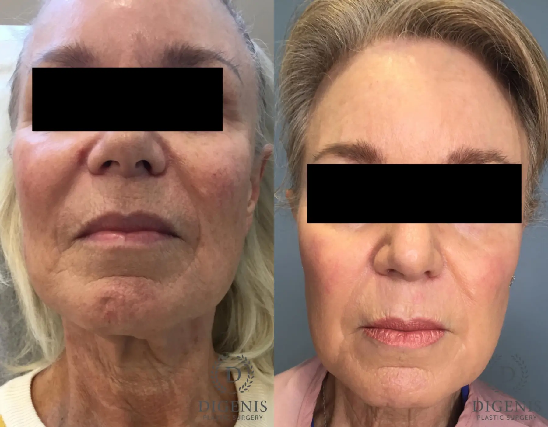 Laser: Patient 1 - Before and After  