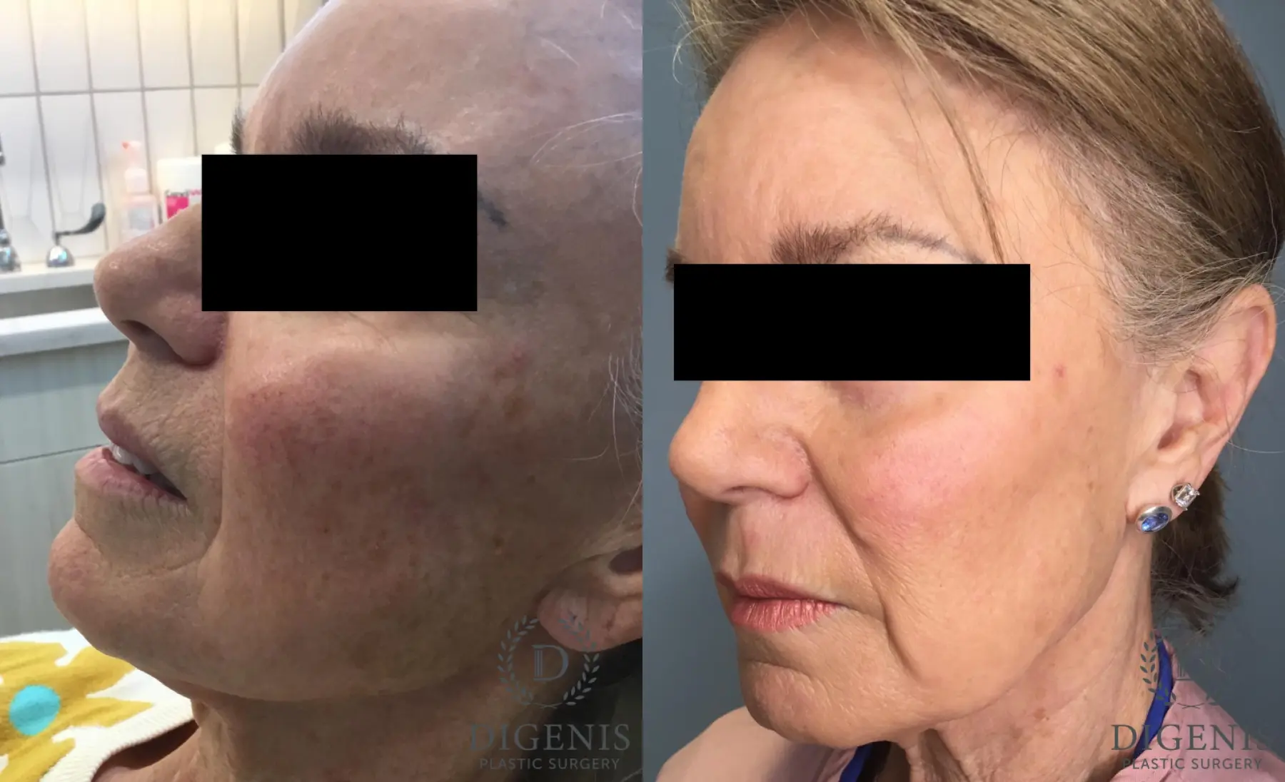 Laser Skin Resurfacing: Patient 2 - Before and After 3