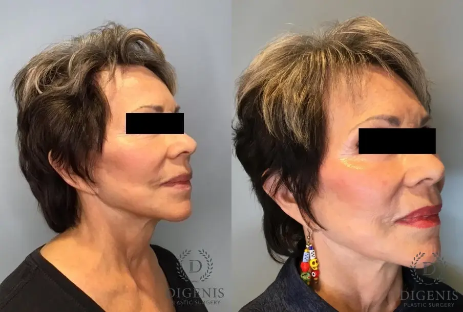 Laser Skin Resurfacing: Patient 1 - Before and After 3