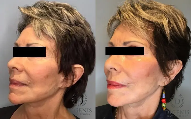 Laser Skin Resurfacing: Patient 1 - Before and After 5