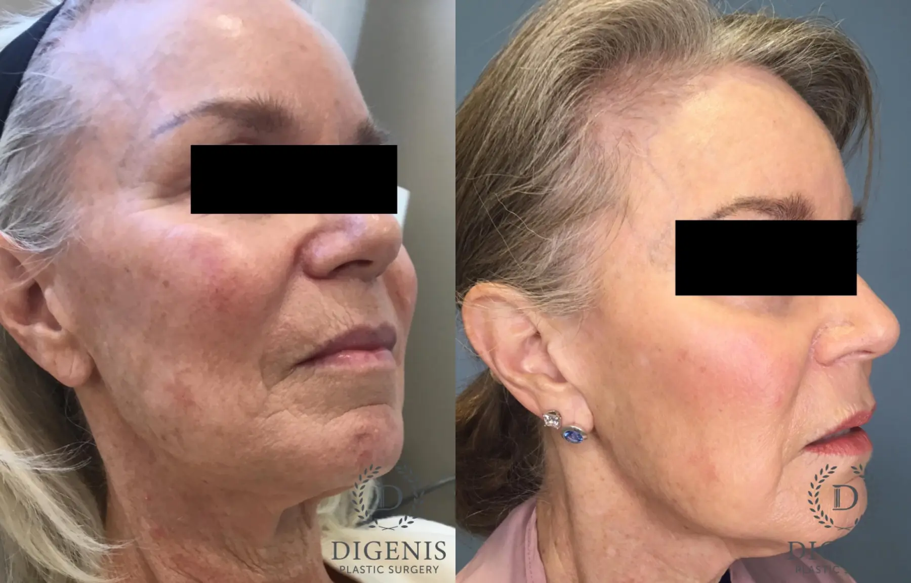 Laser Skin Resurfacing: Patient 2 - Before and After 2