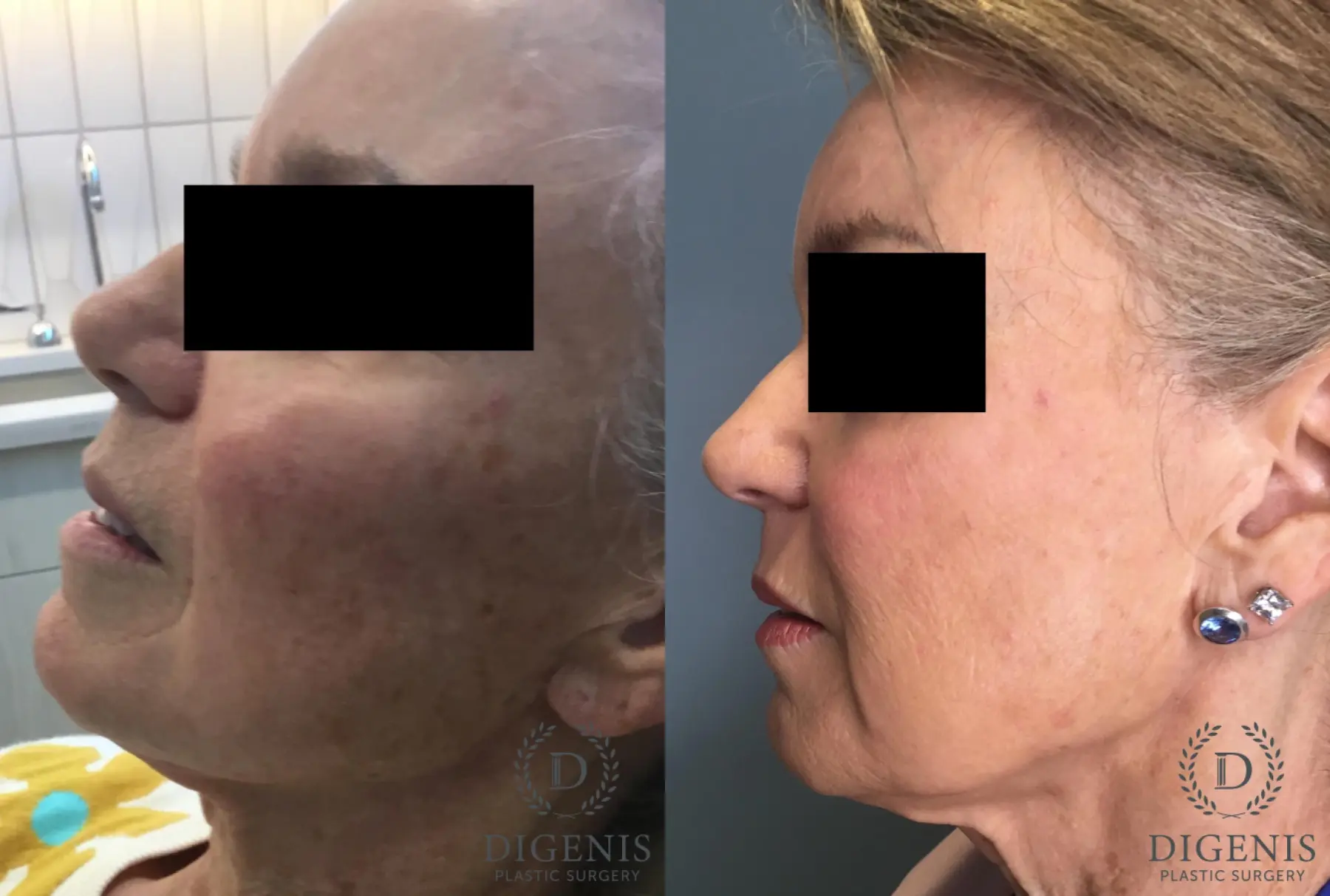 Laser Skin Resurfacing: Patient 2 - Before and After 4