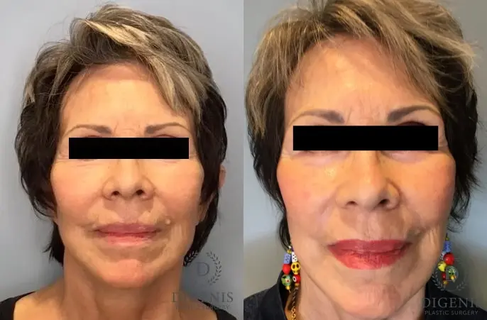 Laser Skin Resurfacing: Patient 1 - Before and After  