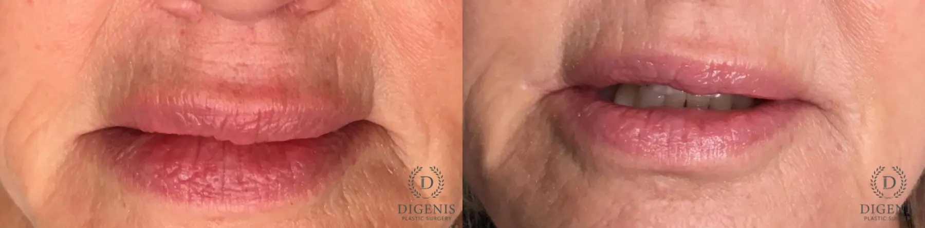 Lip Augmentation: Patient 1 - Before and After  