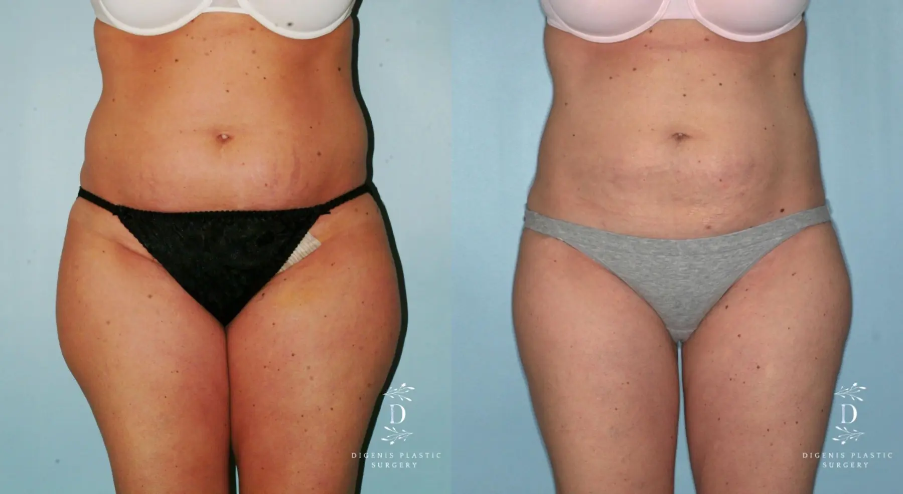Liposuction: Patient 7 - Before and After 1