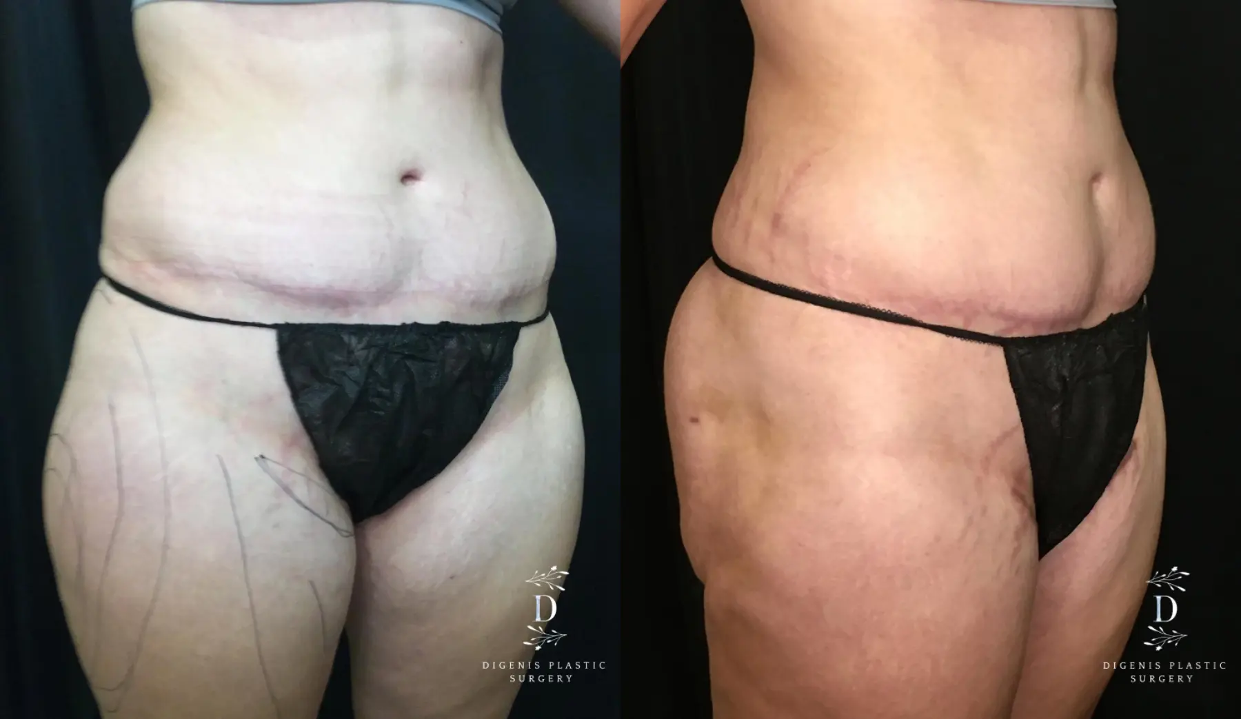 Liposuction: Patient 10 - Before and After 2