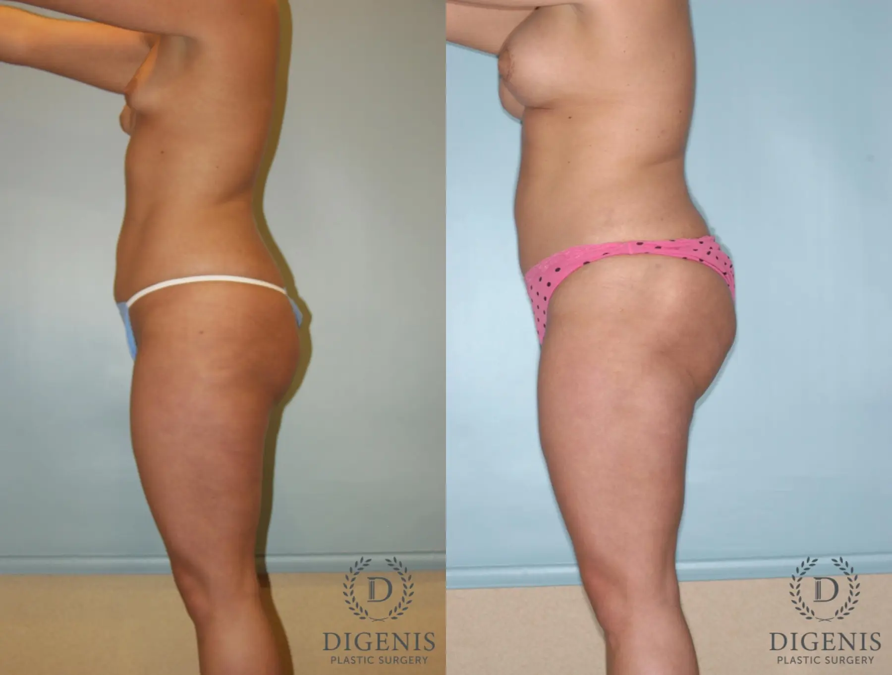 Liposuction: Patient 5 - Before and After 4