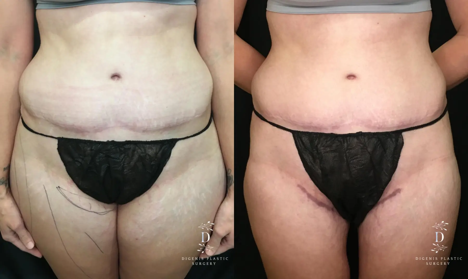 Liposuction: Patient 10 - Before and After  