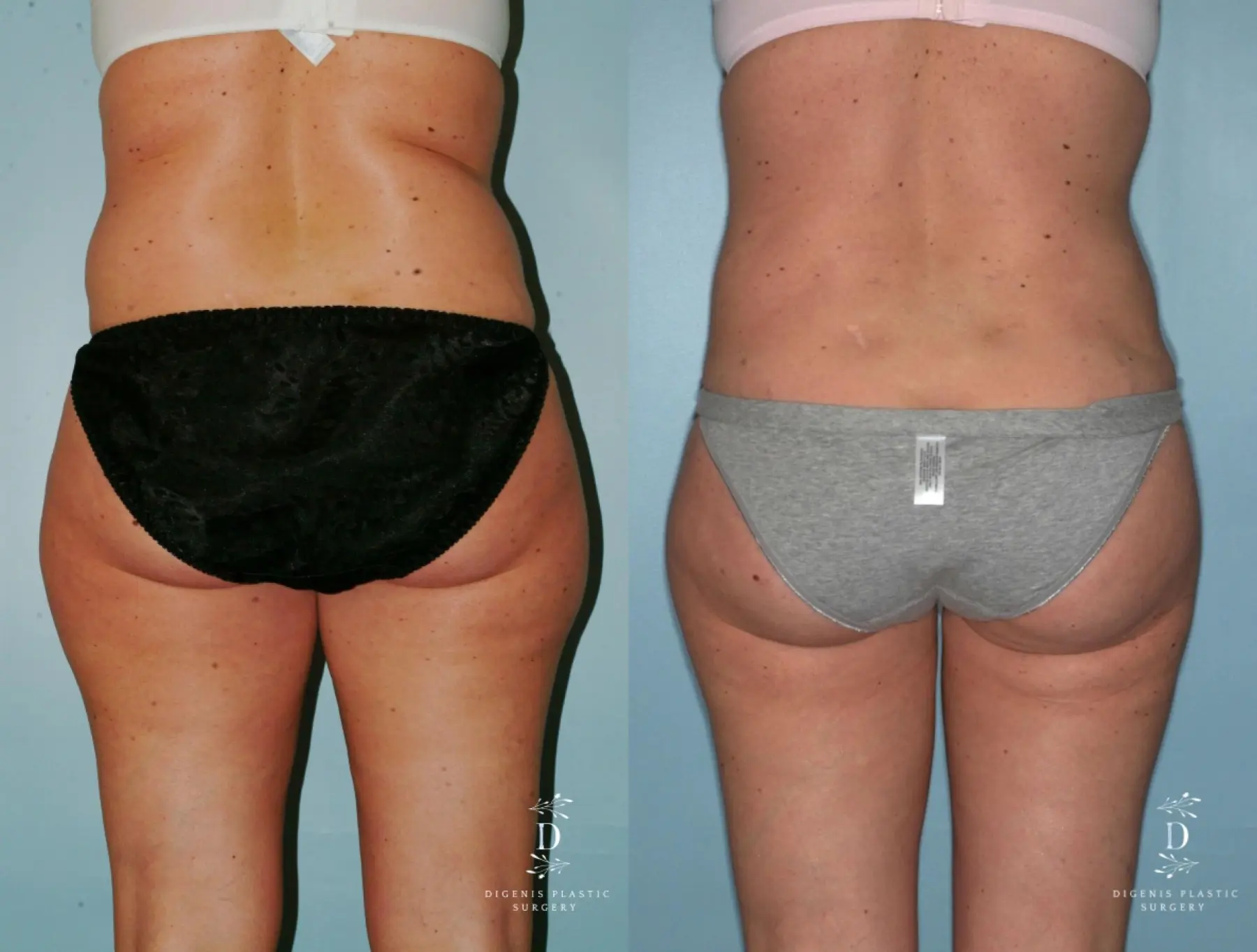 Liposuction: Patient 7 - Before and After 4